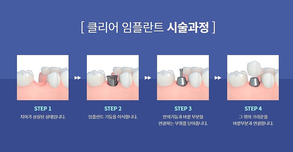클리어치과 임플란트 이젠 고민 그만하고 관련 이미지 7