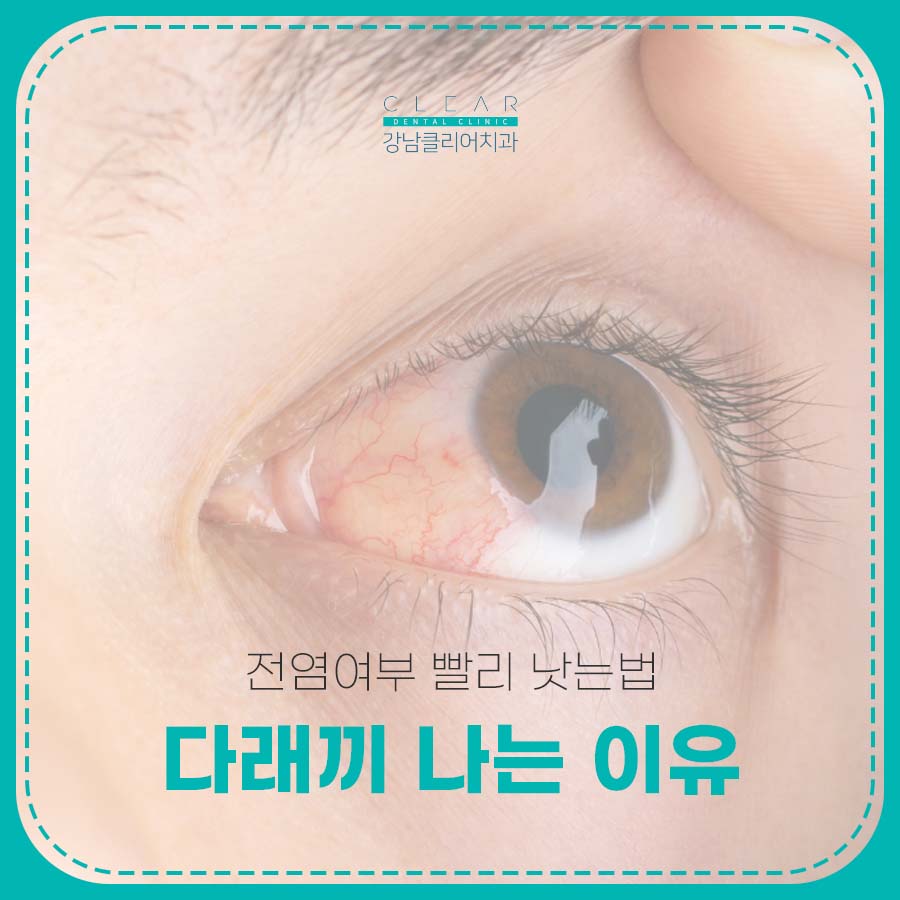 다래끼 나는 이유 전염여부 빨리 낫는법 관련 이미지 1