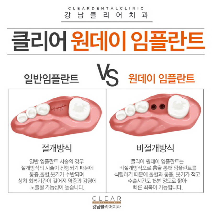 강남역임플란트 경구진정법 수면치료로 편안하게 관련 이미지 7