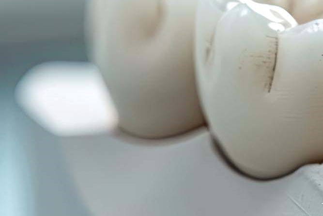 임플란트 구조 수명은 어느정도? 관련 이미지 18