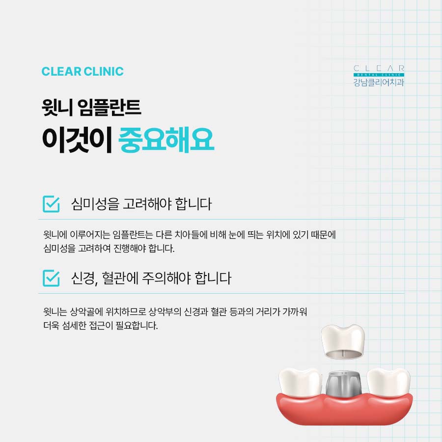 윗니 임플란트 지르코니아로 내 치아처럼 관련 이미지 2