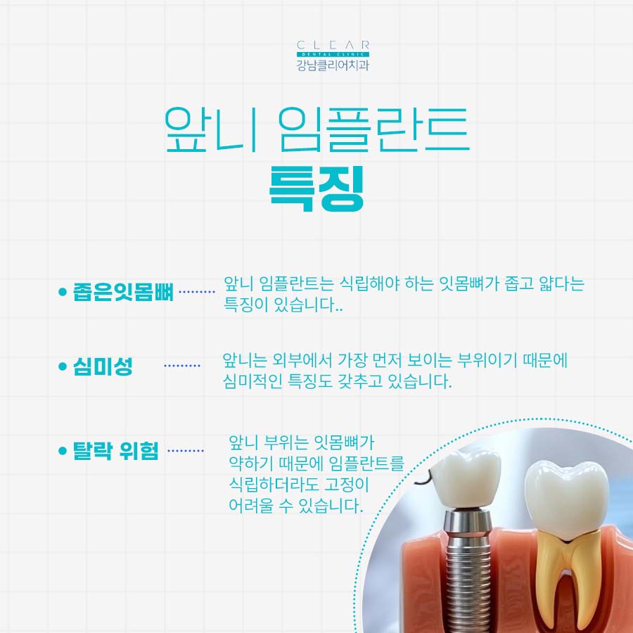 서초동 임플란트 앞니 식립 하려면 관련 이미지 2
