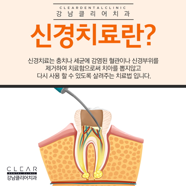 치아 신경치료 하는이유 자연치아 살리기 관련 이미지 2