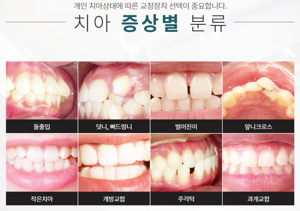 반포동치아교정 반듯한 치아를 갖고 싶다면 관련 이미지 2
