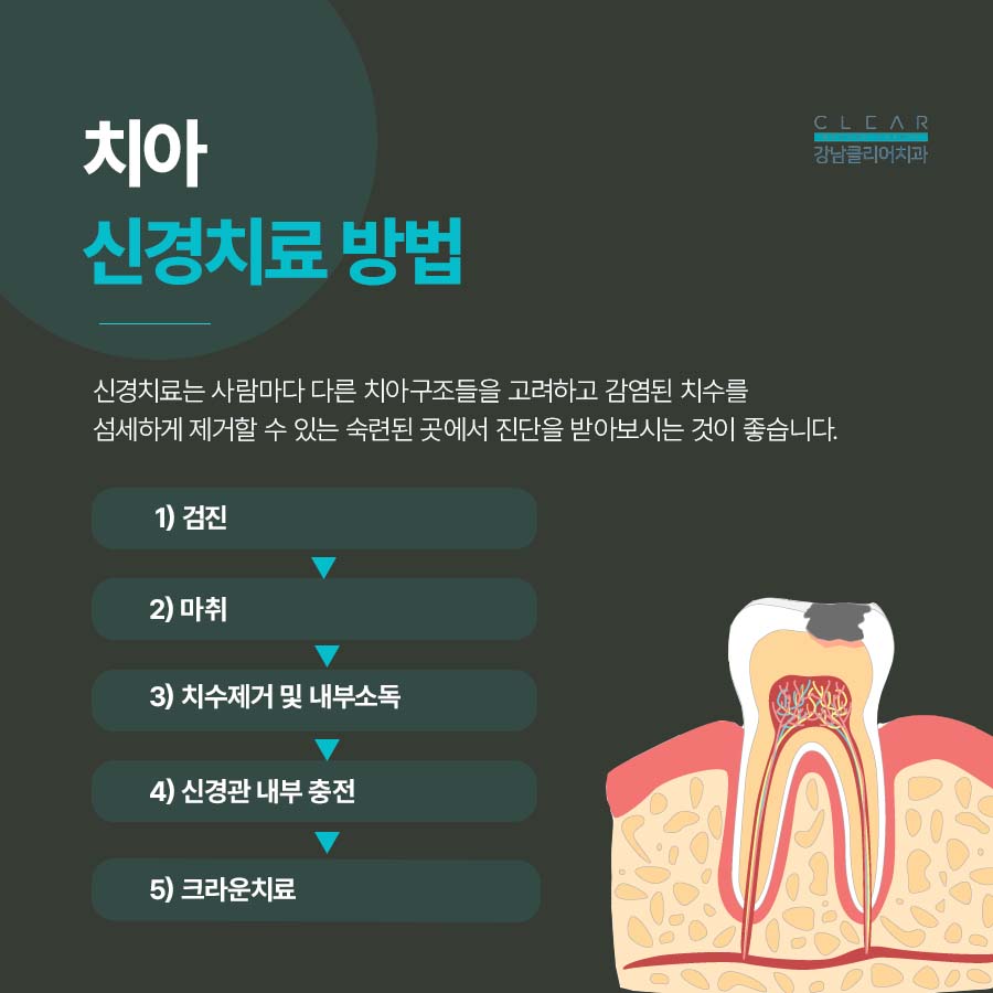 신경치료 후 크라운 꼭 해야되는 이유 관련 이미지 2