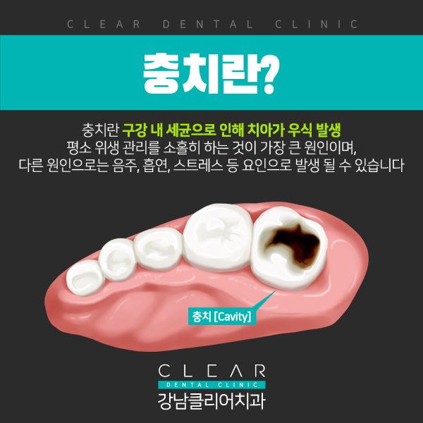 강남충치치료 레진,인레이 단계별 치료방법 관련 이미지 1