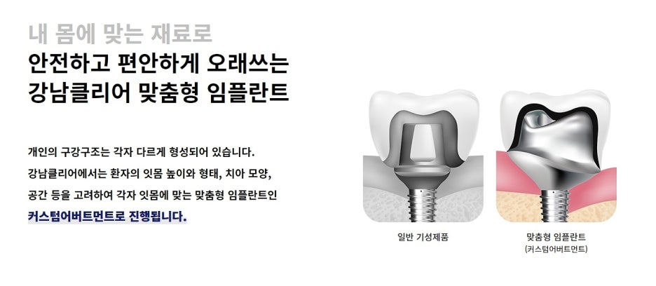강남역 임플란트 잘하는곳 판단하고 결정해야 관련 이미지 7