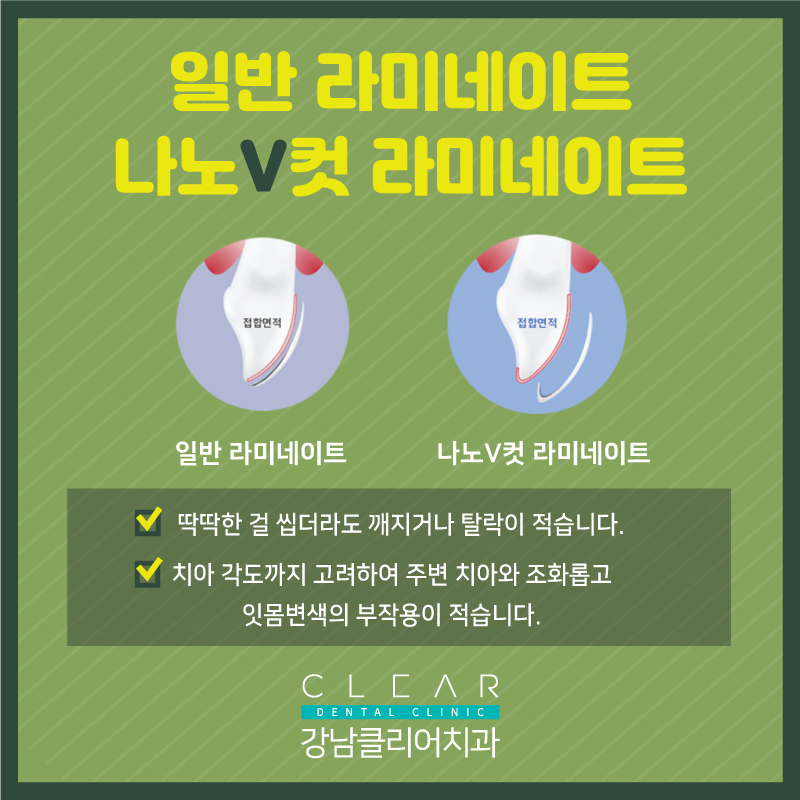 강남라미네이트 자연스러운 아름다움! 나노v컷 라미네이트 관련 이미지 5
