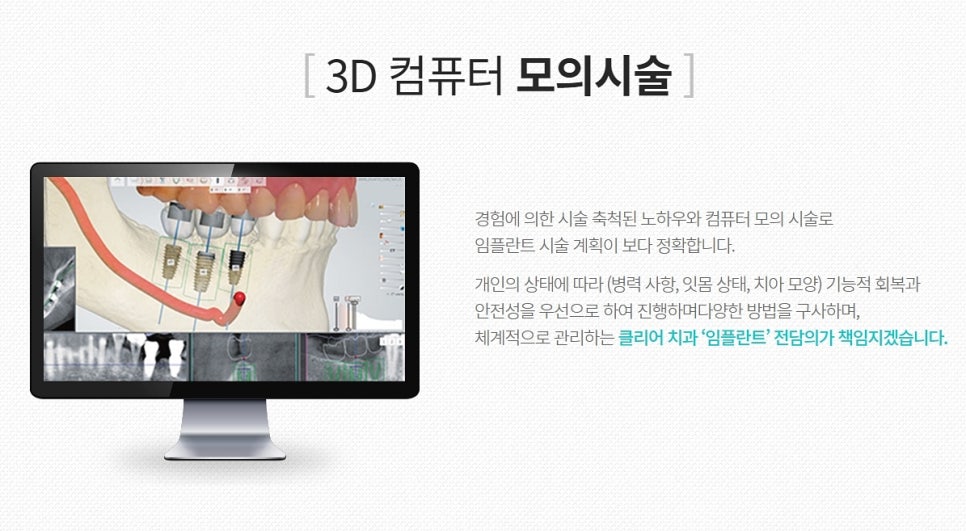 임플란트의 종류 남다른 방법 관련 이미지 6