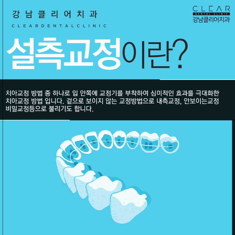 설측교정 교정한거 아무도 몰라요 관련 이미지 2