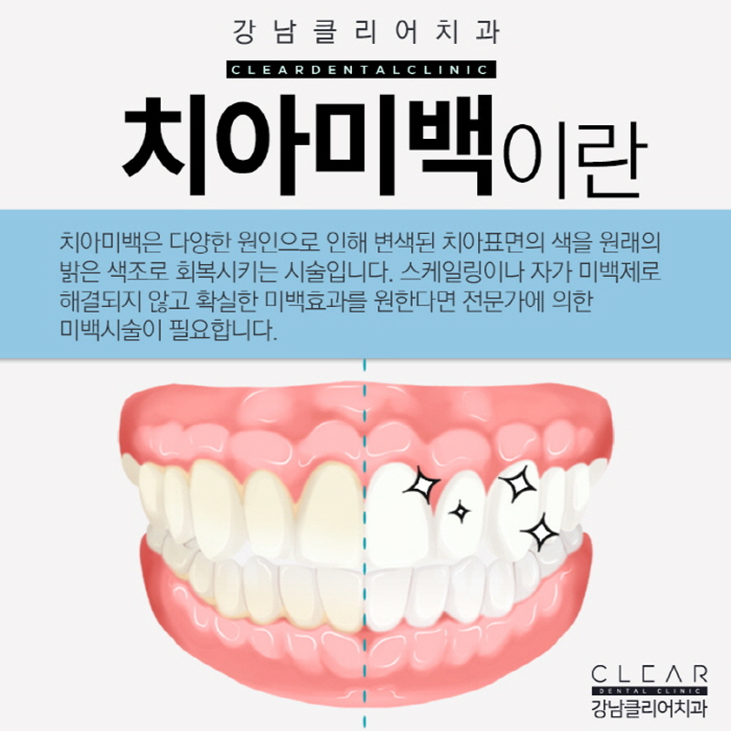 강남역치아미백 미소를 되찾아 주기 관련 이미지 3