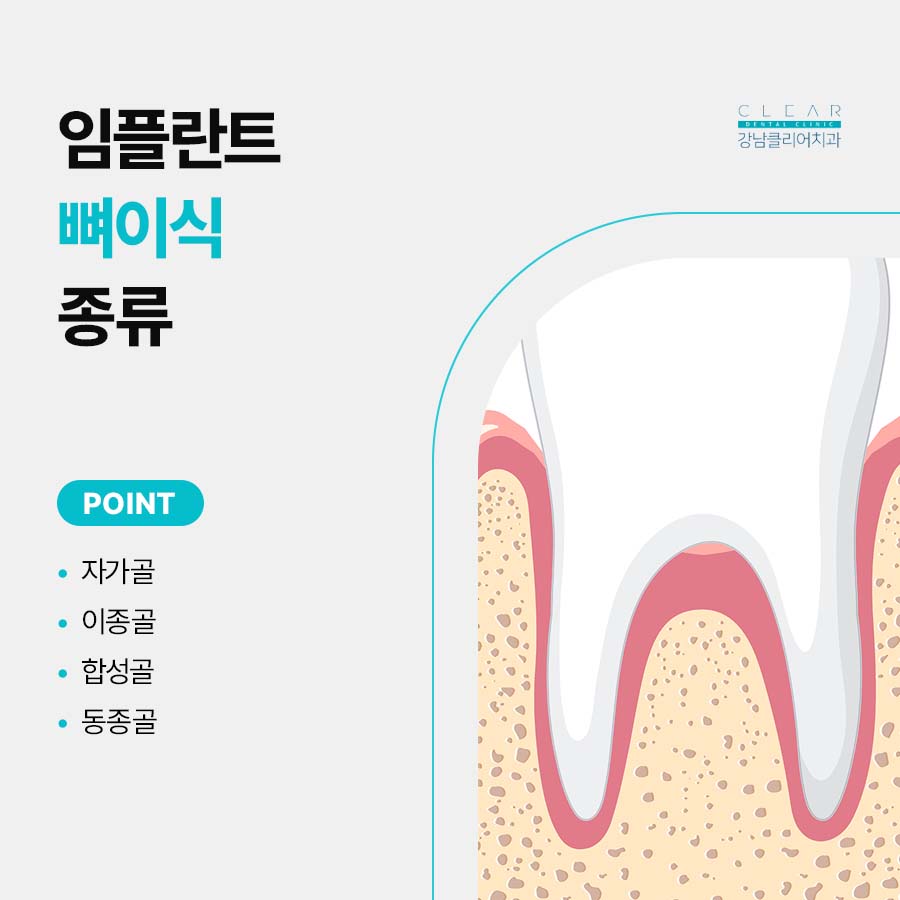 임플란트뼈이식수술 뼈이식 종류 주의사항은? 관련 이미지 4