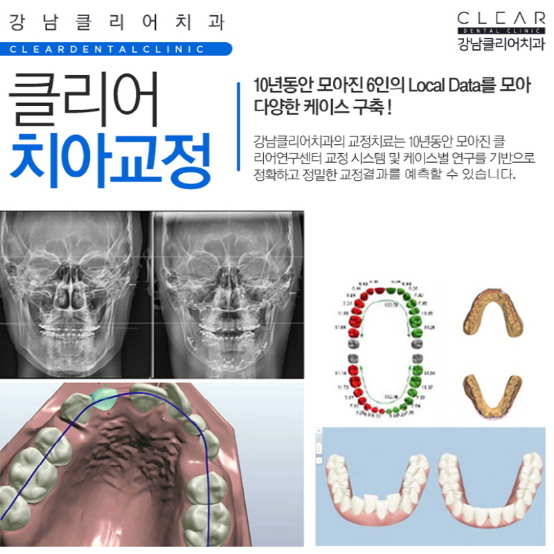 강남역 투명교정 가격 후기 치과 투명교정치료 모든것 관련 이미지 5
