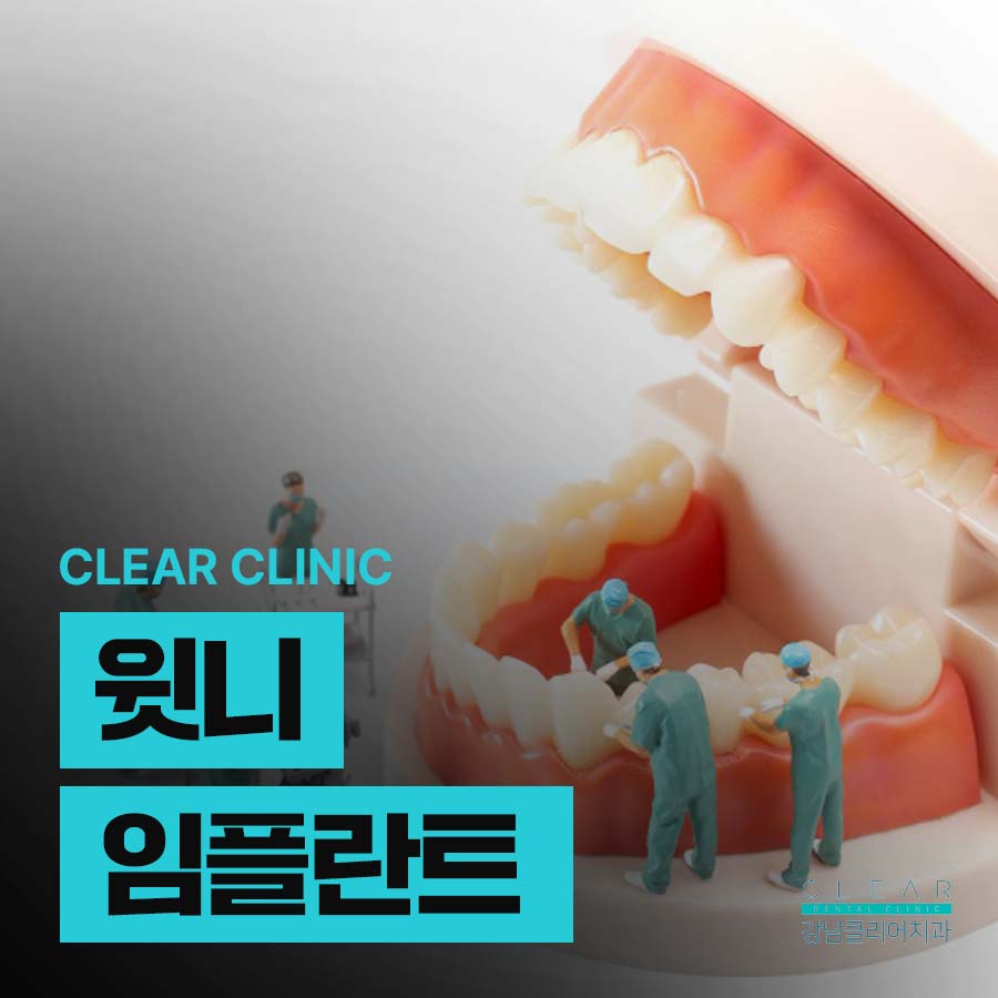 윗니 임플란트 지르코니아로 내 치아처럼 관련 이미지 1