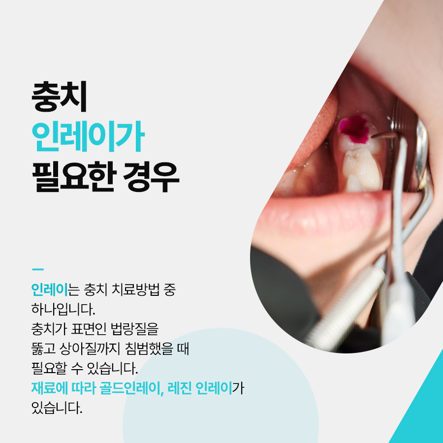 강남역 충치치료 인레이 크라운 차이 비교 관련 이미지 2