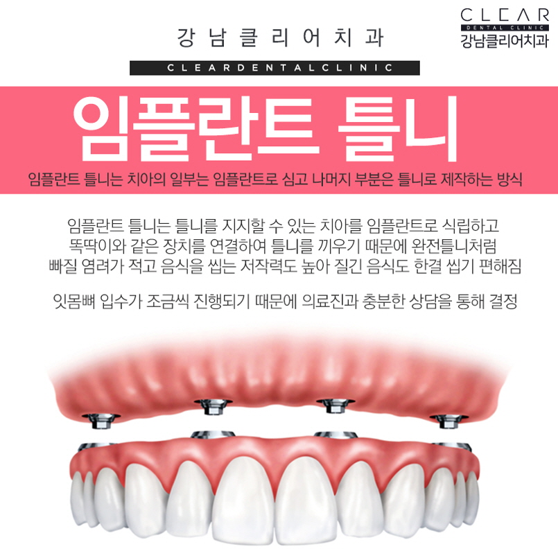 노인 틀니 임플란트틀니 가격 부담줄이기 관련 이미지 6