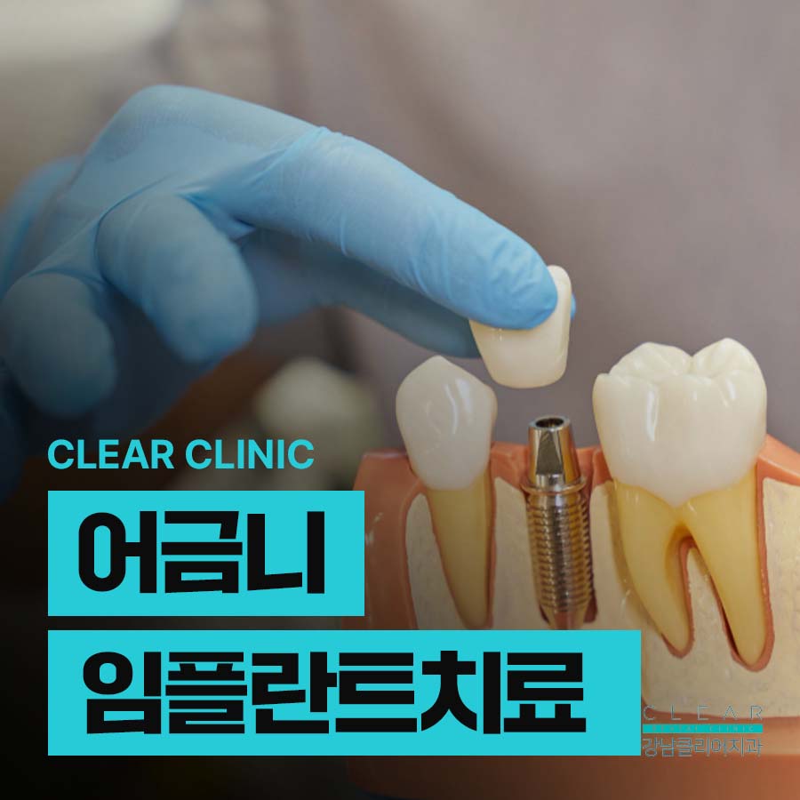 어금니임플란트치료 시 고려해야하는 점 관련 이미지 1