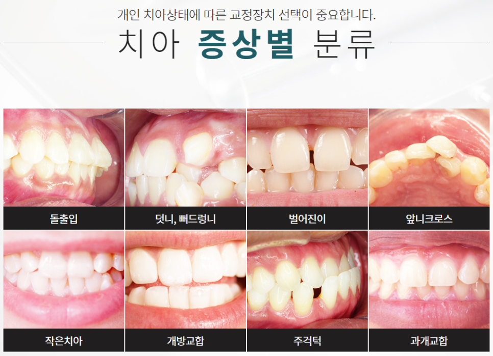 강남교정치과 후기 궁금하다면 투명교정 알아봐요 관련 이미지 3