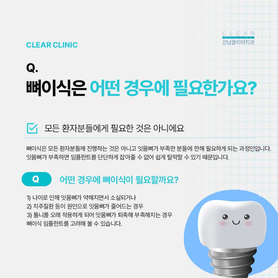 강남클리어치과에서 임플란트 재료 뼈이식 수술시간 정리해드려요 관련 이미지 4