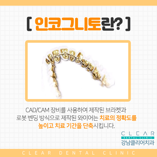 강남역 안보이는 시크릿교정 설측교정! 관련 이미지 6