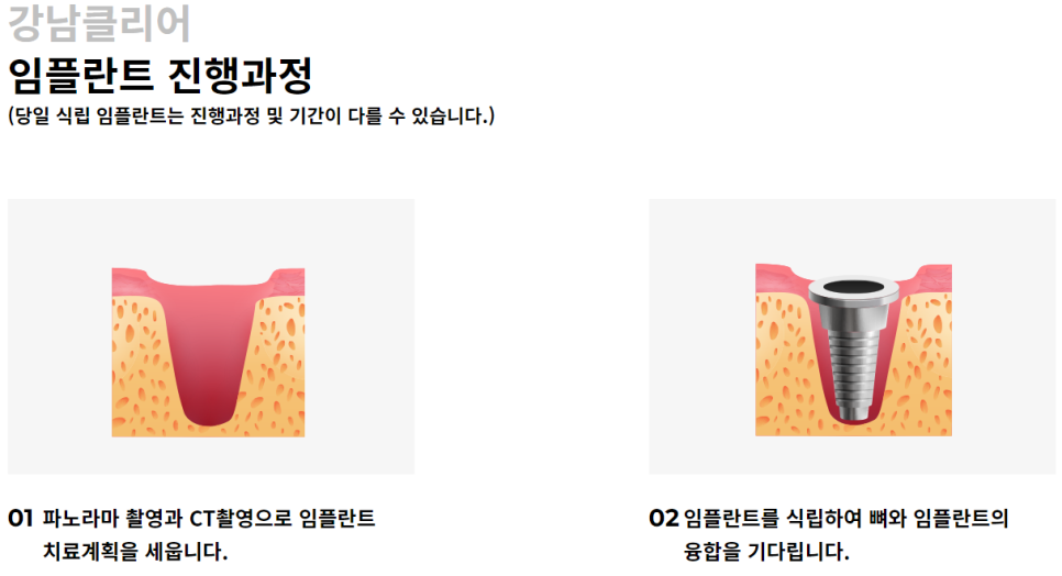 역삼동임플란트 수준 높은 곳을 찾는다면? 관련 이미지 6