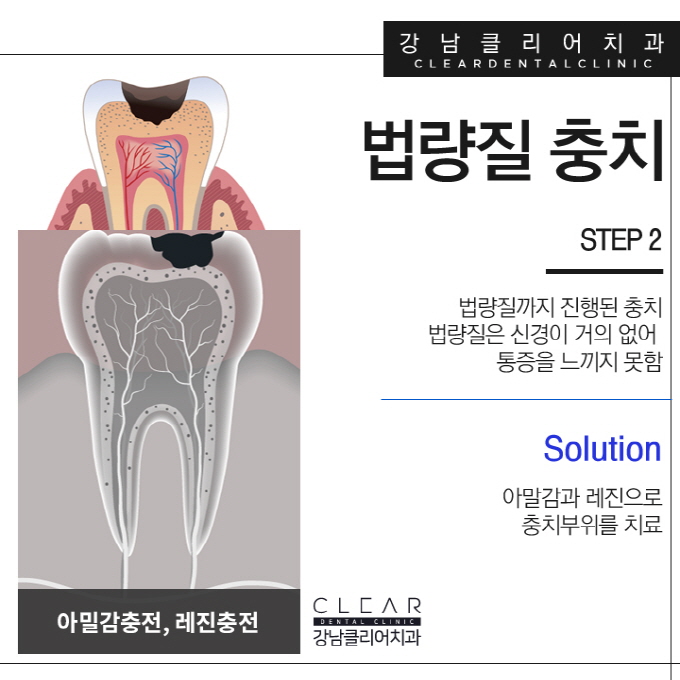 강남역충치치료 단계별 달리지는 치료방법 관련 이미지 5