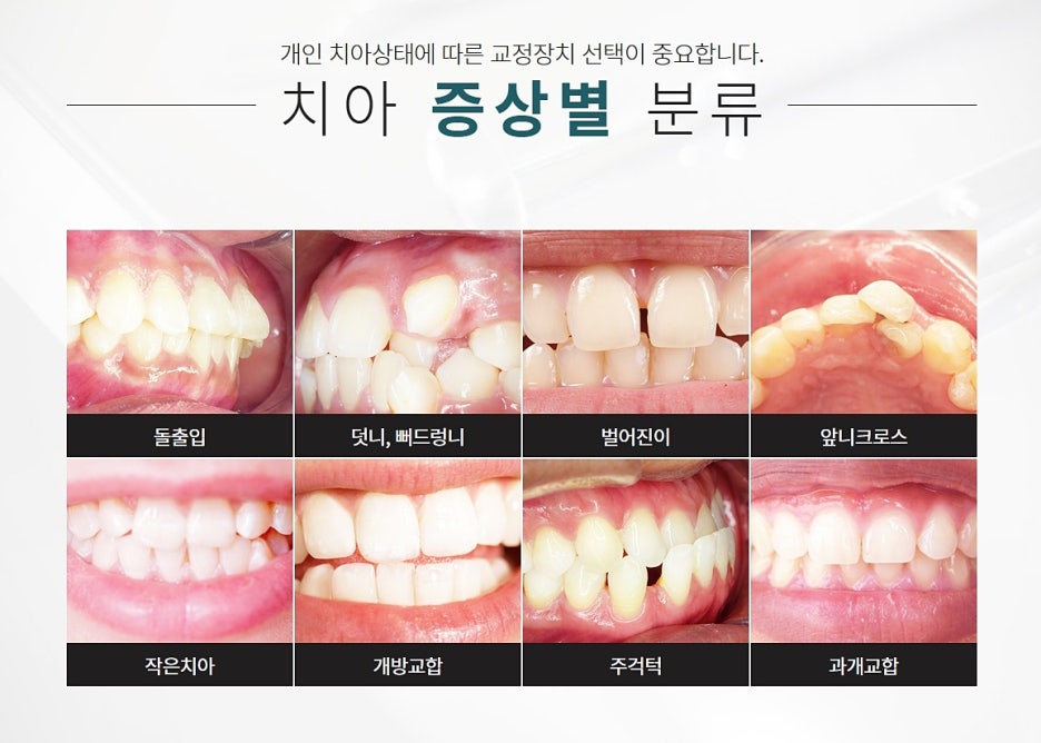 강남 클리피씨 교정으로 만족도 높이기 관련 이미지 4