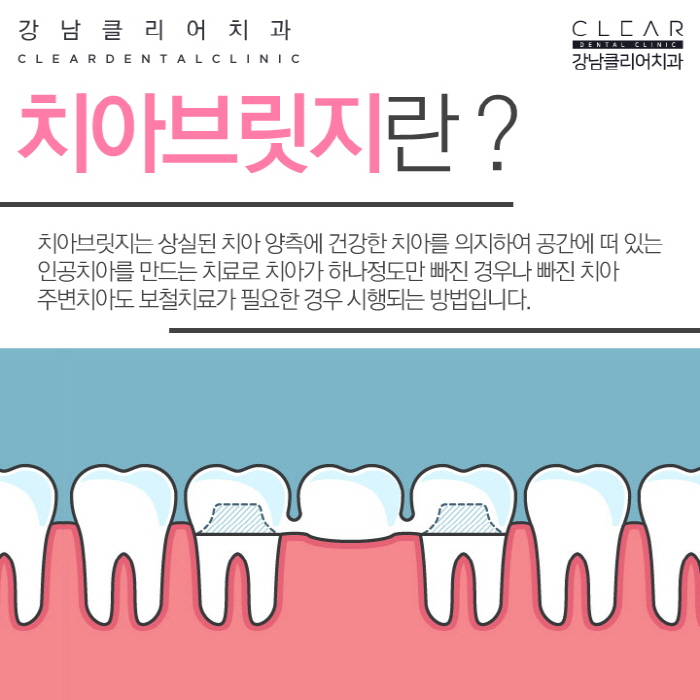 치아 보철치료 종류 심미보철 등 다양해 관련 이미지 8