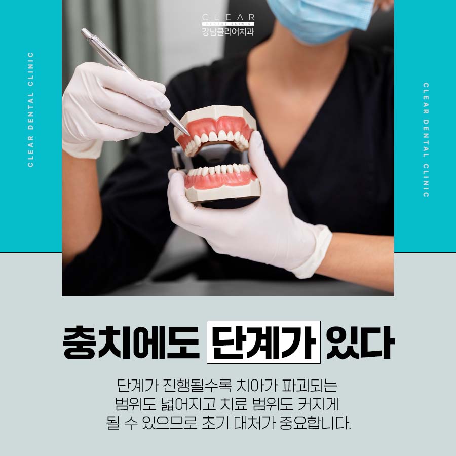 치아 인레이 이럴때 필요해요 관련 이미지 2