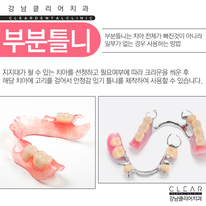 치아 보철치료 종류 심미보철 등 다양해 관련 이미지 11