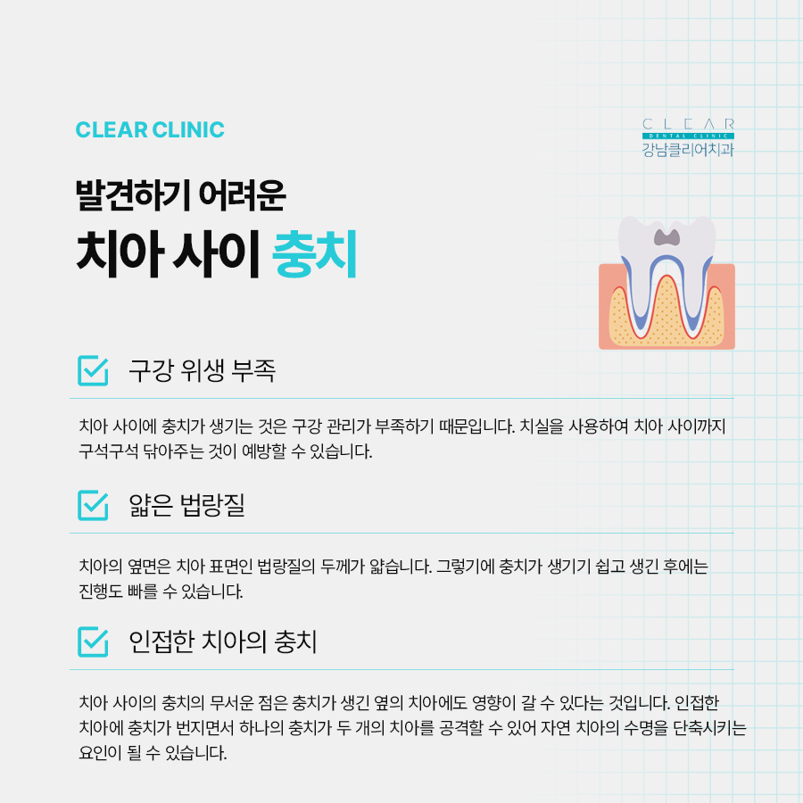 치아 사이 충치 조기에 발견해야 관련 이미지 2