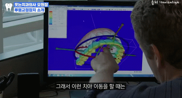 투명교정 무턱대고 했다간 후회합니다 관련 이미지 6