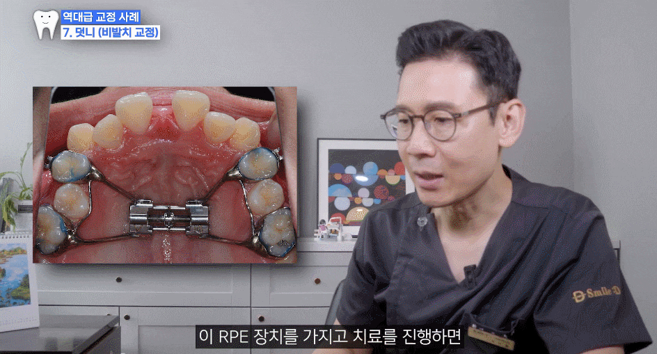악궁확장 장치로 발치 피한 교정 사례, 나도 가능할까? 관련 이미지 6