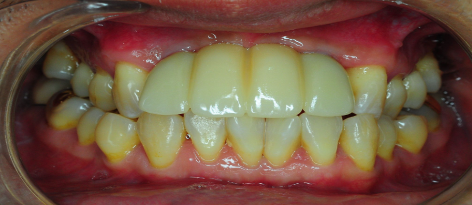 Implant Costs and Health Insurance Implant Coverage Criteria - If You Really Want to Save on Costs image 3