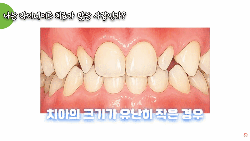 The Side Effects of Front Teeth Veneers, Explained by a Specialist image 12
