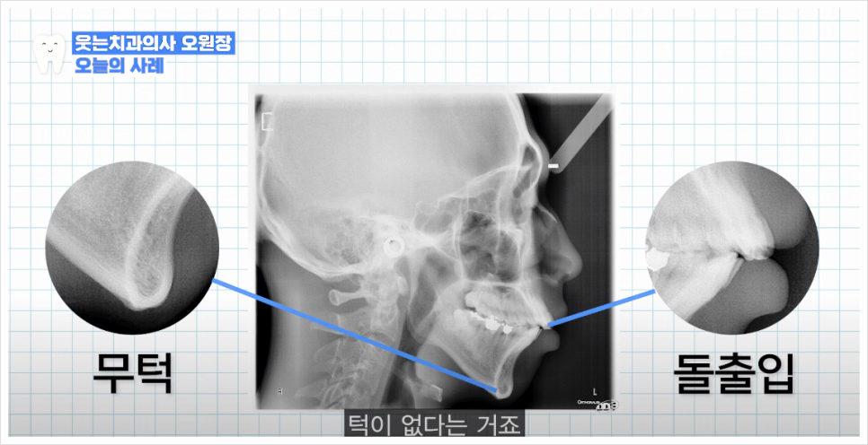 돌출입교정치과 수술 없이 무턱교정으로도 개선 가능합니다 관련 이미지 17
