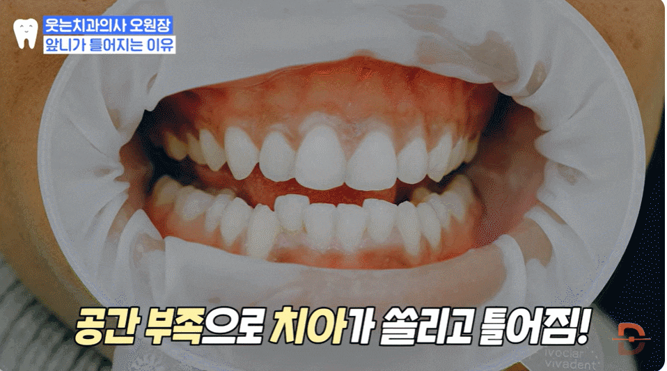 부분교정 장점, 관련 이미지 4