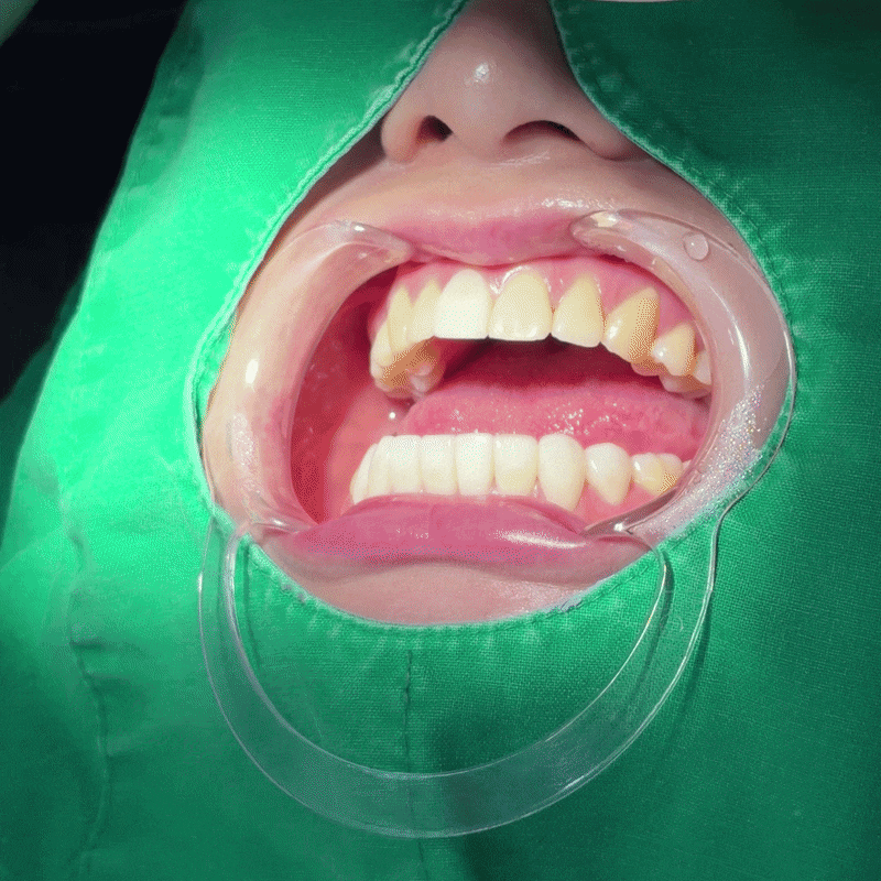 스마일랩핑이란? 무삭제 가능 여부부터 원데이 치료까지 <총정리> 관련 이미지 17