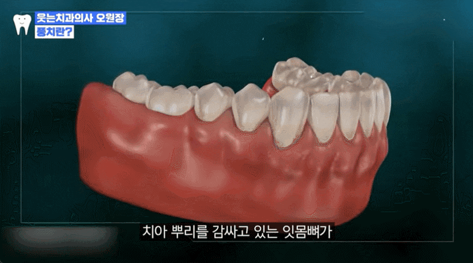 풍치 원인과 예방법, 10년 후에도 건강한 잇몸 유지하려면 필독 관련 이미지 3