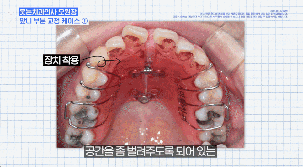 무턱교정전후, 얼굴 라인 어떻게 달라지는지 <공개> 관련 이미지 3