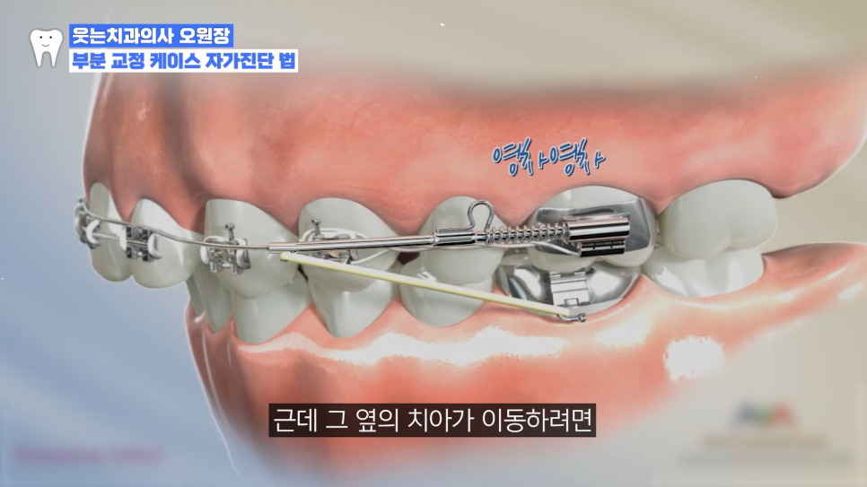 Can Extractions That Affect the Length of Correction for Crowded Canines Be Avoided? image 3