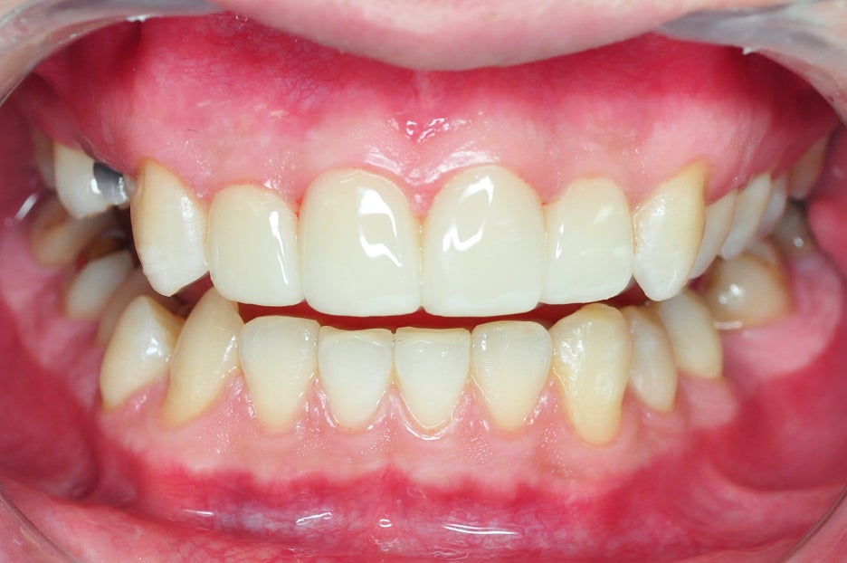 If You Want to Avoid Side Effects from Gangnam Laminate Veneers, Check These 2 Things image 5