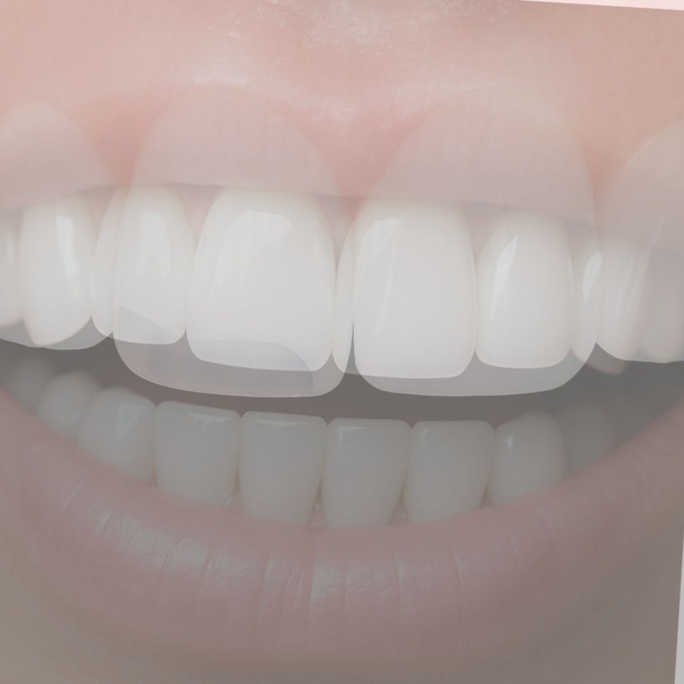 무삭제 라미네이트 후기 꼼꼼히 찾아봤어요 관련 이미지 11