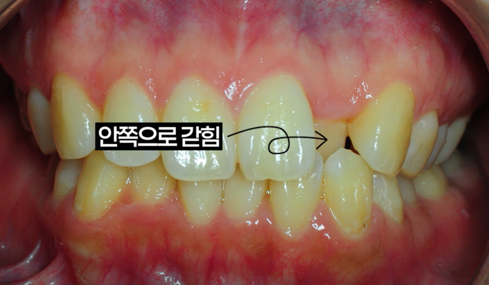 Invisalign Cases: Here’s How Much Can Change Without Brackets image 13