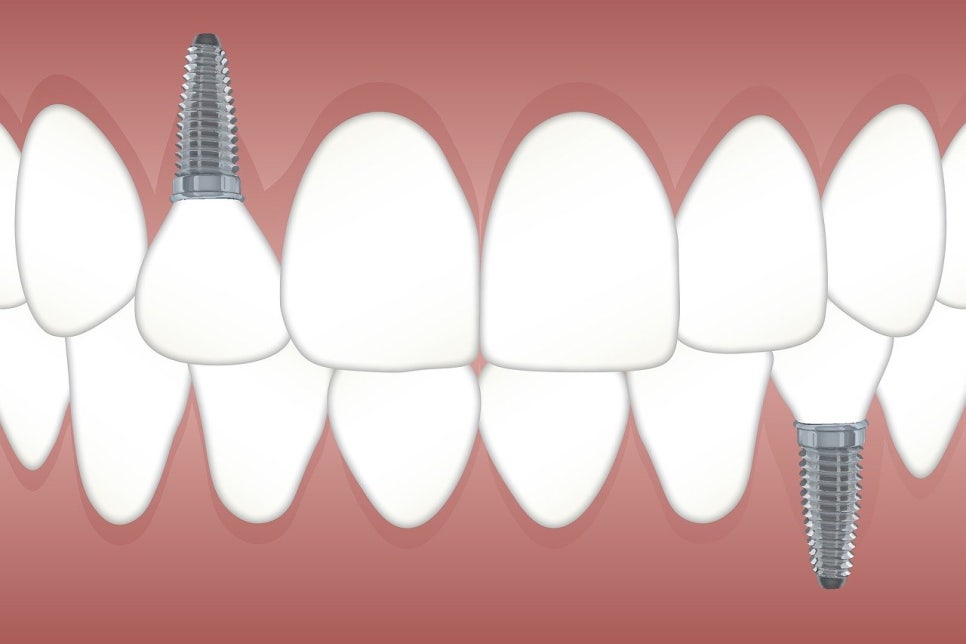 Is Same-Day Implant Possible? What You Must Know Before Implant Surgery image 11