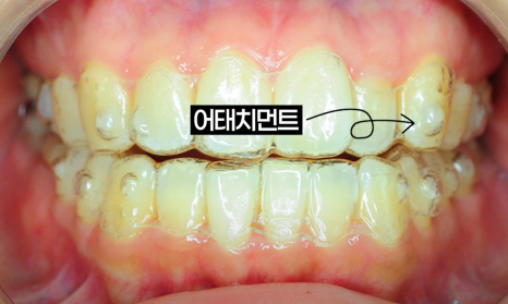 Invisalign Cases: Here’s How Much Can Change Without Brackets image 15