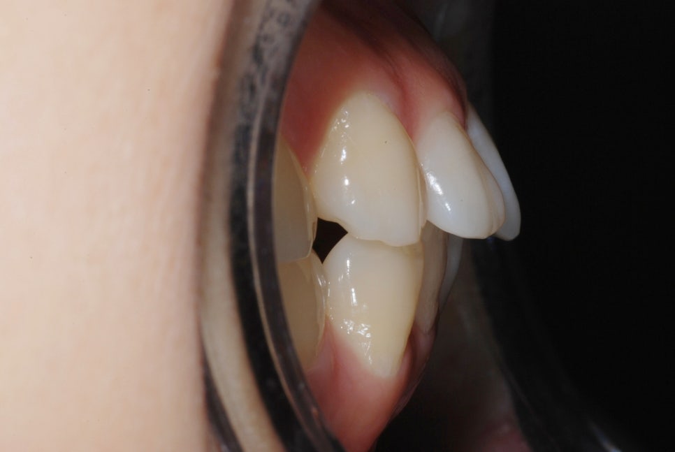 Protruding Mouth Correction and Underbite Correction: A Case Improved Without Surgery image 2