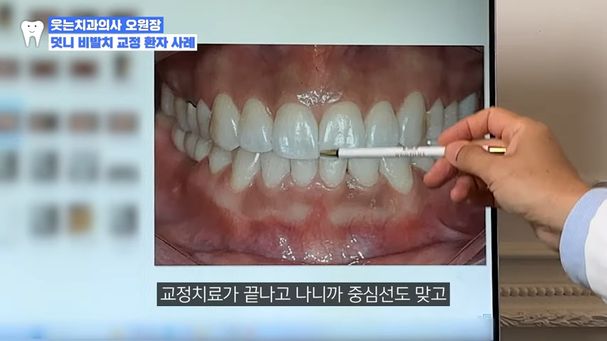 논현동치과 교정치료 실패하지 않으려면 <필독> 관련 이미지 2
