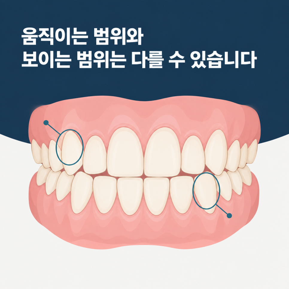 압구정교정치과, 앞니만 가지런하면 끝이라고 생각하셨나요? 관련 이미지 2