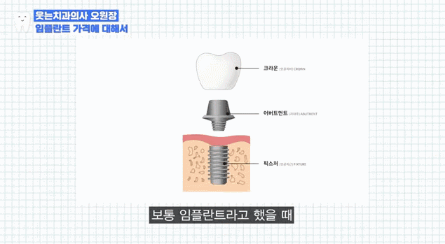 임플란트가격 00만원의 함정, 실제 총비용은 이렇습니다 관련 이미지 3